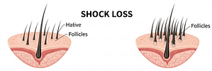 Hair transplantation