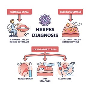 Diagnosis of Herpes Simplex Virus (HSV)