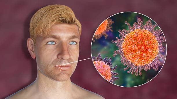 Herpes Simplex Virus (HSV)