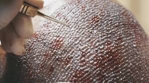 Hair Transplantation (Image Source: Shutterstock)